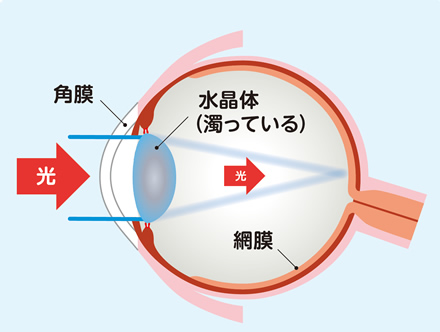 白内障の眼