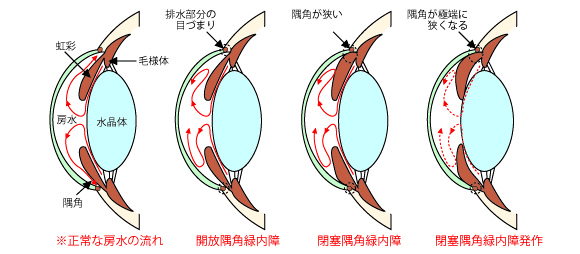 緑内障の種類