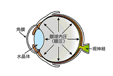 緑内障