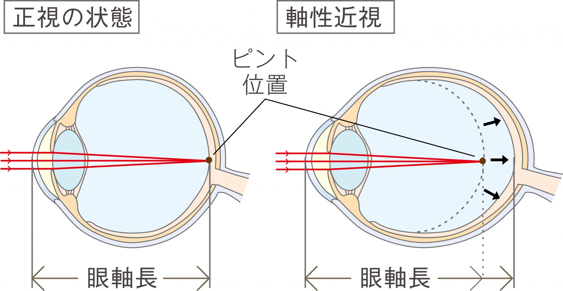 眼軸長の画像